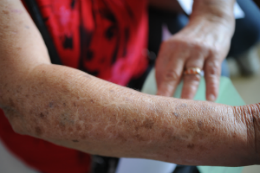 Imagem: O câncer de pele é um dos mais frequentes no Brasil e tem predominância em adultos brancos (Foto: Agência Brasil)
