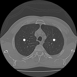 Imagem de tomografia computadorizada de alta resolução (TCAR) do pulmão (Foto: Reprodução)