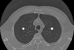 Imagem de tomografia computadorizada de alta resolução (TCAR) do pulmão (Reprodução)