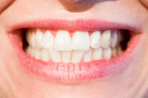 Imagem: Usando magnetismo, o produto é capaz de "puxar" as enzimas chamadas metaloproteinases, reduzindo as chances de degradação dos dentes (Foto: PxHere)